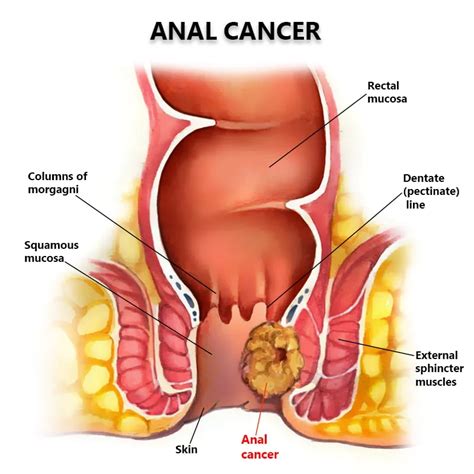 Anal Cancer Photos