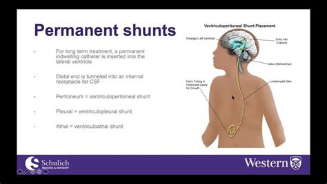 Anesthesia For Csf Shunting Procedures Youtube
