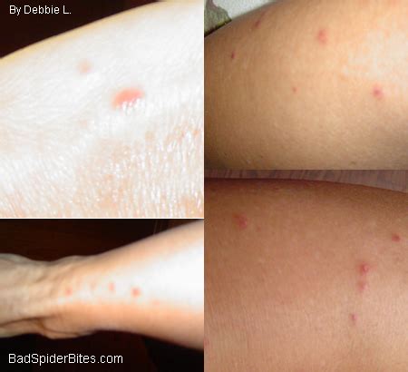 Asian Lady Beetle Bite