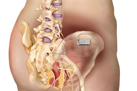 Axonics Sacral Nerve Modulation For Bladder Control Youtube Axonics Sacral Nerve Modulation For Bladder Control Youtube
