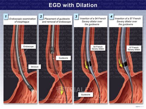 EGD with Bravo: Unlocking Seamless Endoscopic Guidance