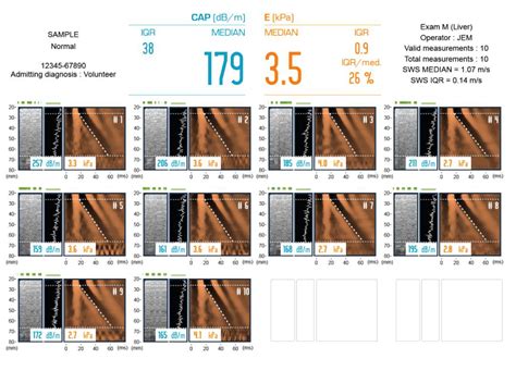 Fibroscan An Overview Sciencedirect Topics