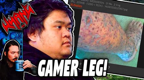 5 Ways Fix Gamer Leg