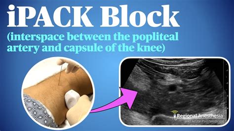 Discover How ipack block Boosts Recycling Efficiency Beyond Expectations