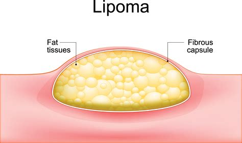 Lipoma