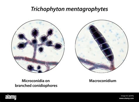 Don't Confuse Macroconidia and Microconidia: Avoid Common Culturing Mistakes