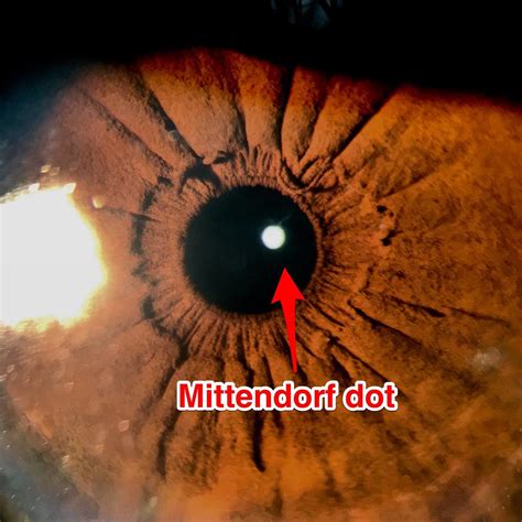 Understanding Mittendorf Dot: A Beginner's Guide to Its Significance