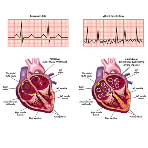 Overview Of Atrial Fibrillation