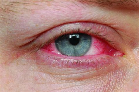 Understanding Pink Eye Images: Causes, Symptoms, and Visual Insights