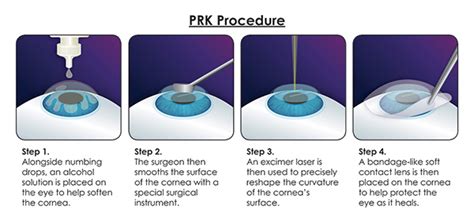 The Ultimate Definitive Guide to the PRK Procedure for Vision Correction