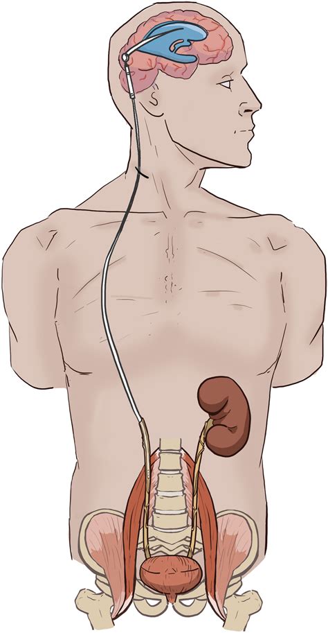 Ventriculo Ureteral Shunt With Nephrectomy Download Scientific Diagram